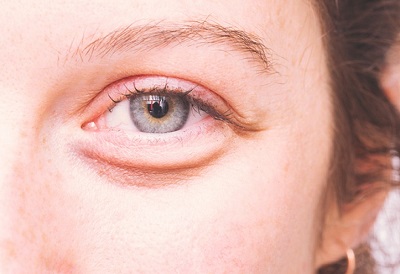 cernes-et-poche-sous-les-yeux