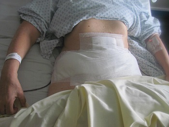 gonflement abdominoplastie