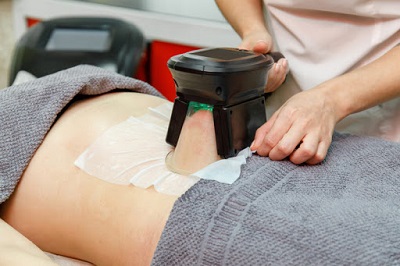 procedure coolsculpting