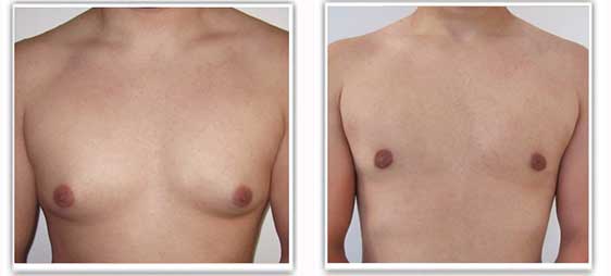 gynecomastie tunisie avant apres