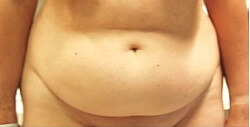 photos abdominoplastie 