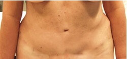 photos chirurgie esthetique du ventre tunisie