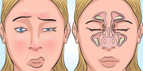 Obstruction nasale : Causes et traitements de mauvaise respiration